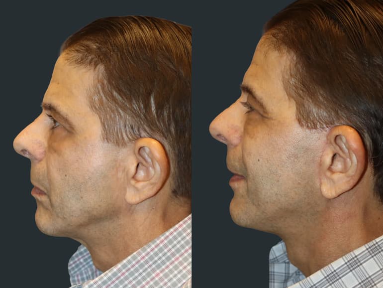 Before and After of a real Dr. Patt patient