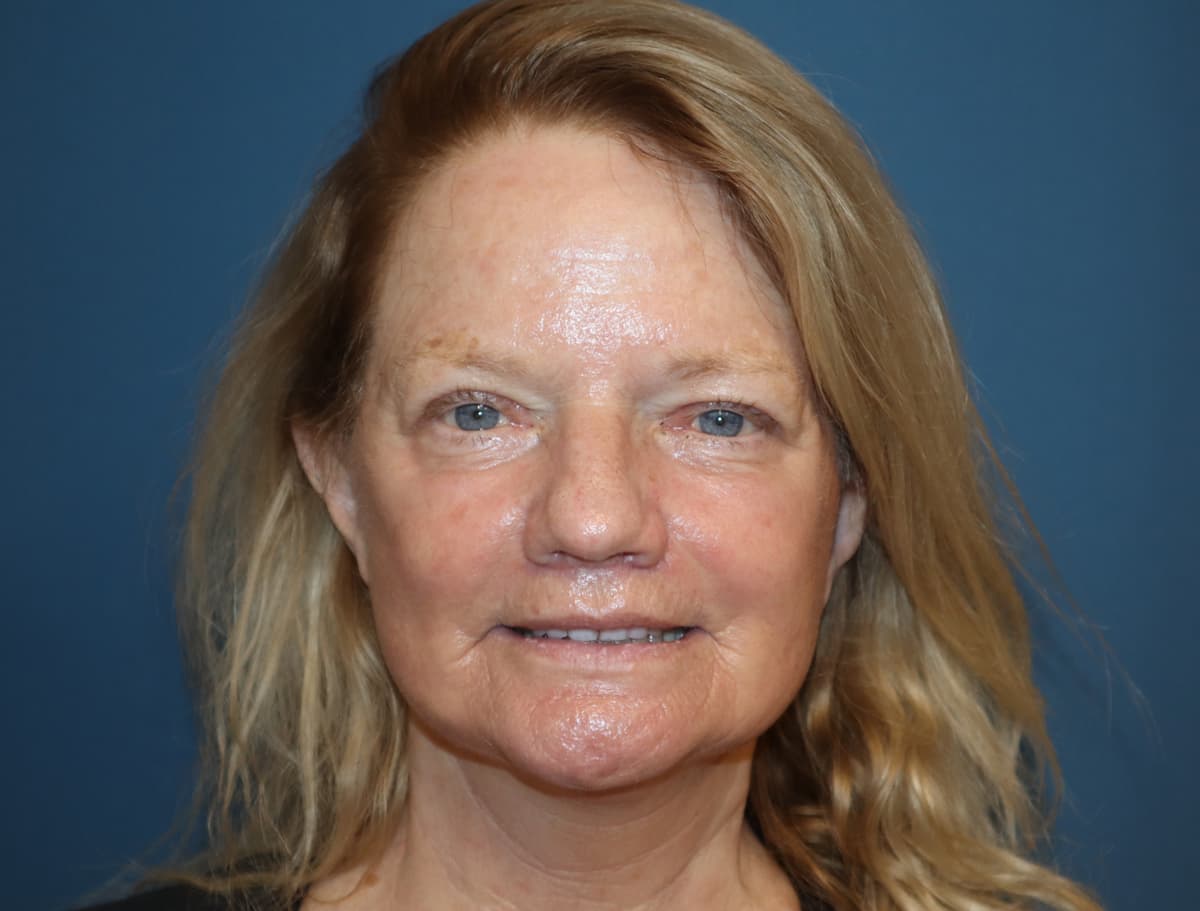 Facelift After Image