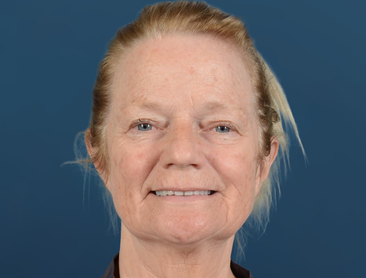 Facelift Before Image