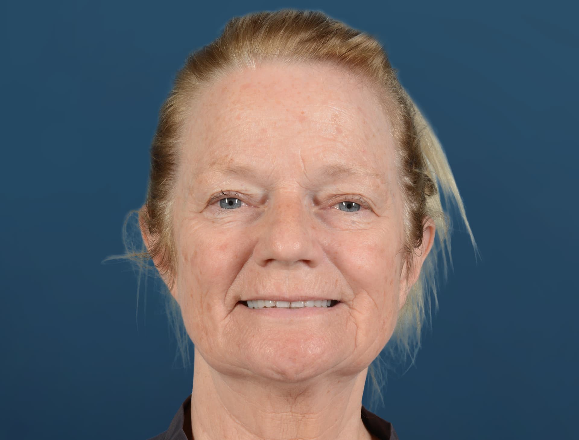 Facelift Before Image