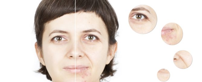 Before and after image of an adult suffering from facial acne.