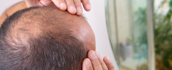 Middle-aged man concerned with hair loss. Baldness
