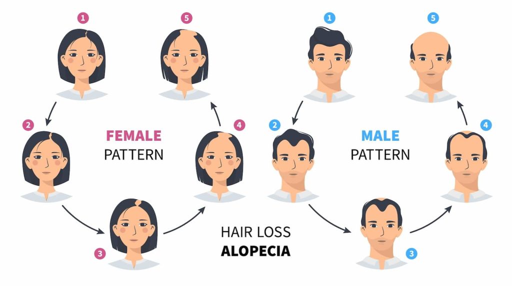 Graphic showing hair loss patterns