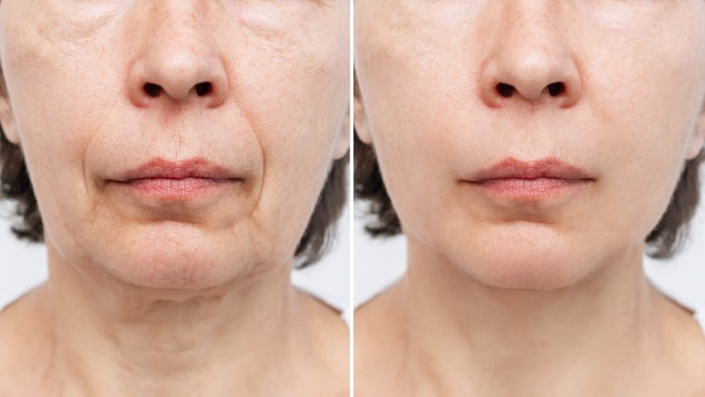 Before and after a facelift treatment