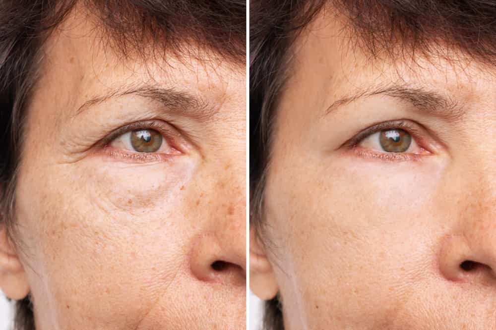 tear trough management fillers vs blepharoplasty