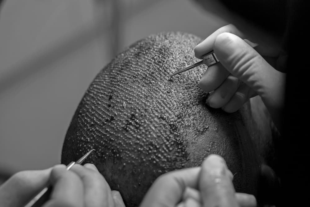 Hair restoration techniques and technology