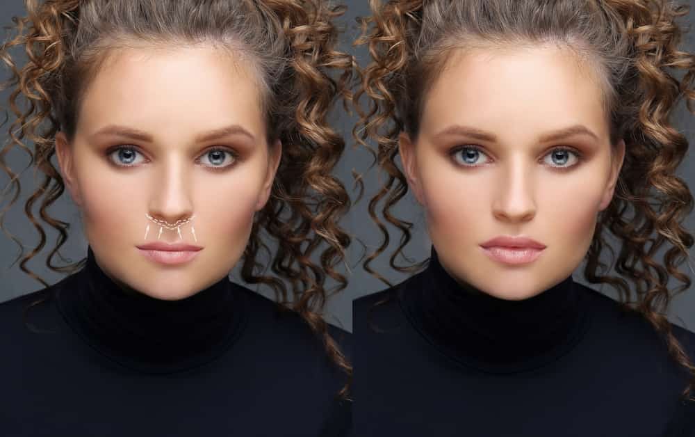 Before and after lip lift procedure