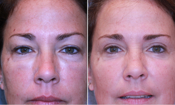 Close-up of woman's face before and after eyelid surgery in Houston, TX, by Dr. Bradford Patt.