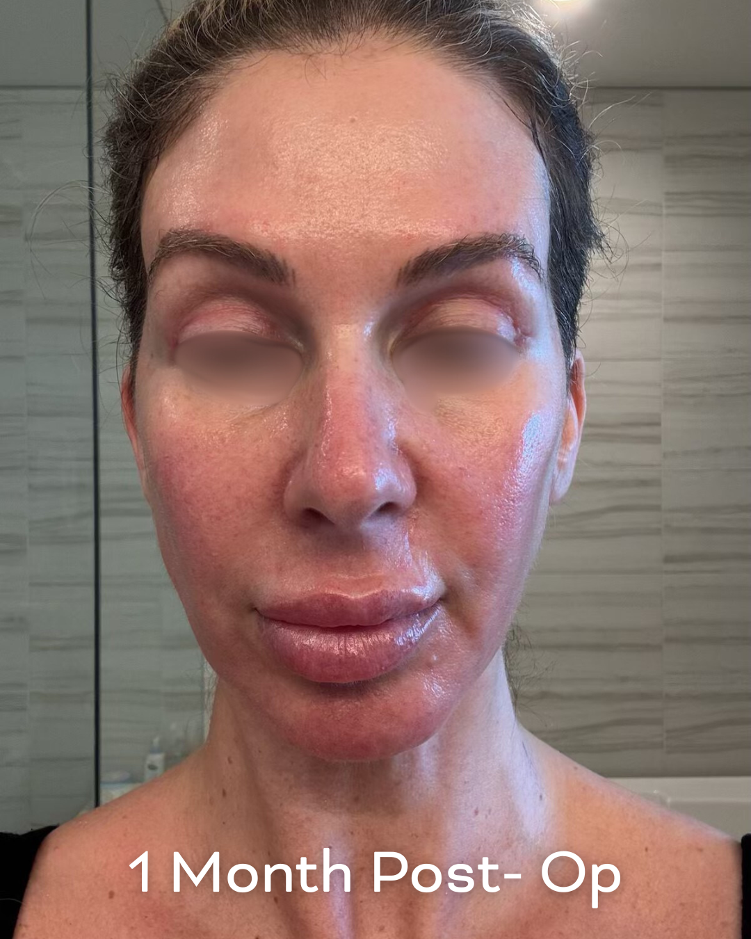 Deep plane lower face and necklift, upper blepharoplasty and Ultrapulse C02 