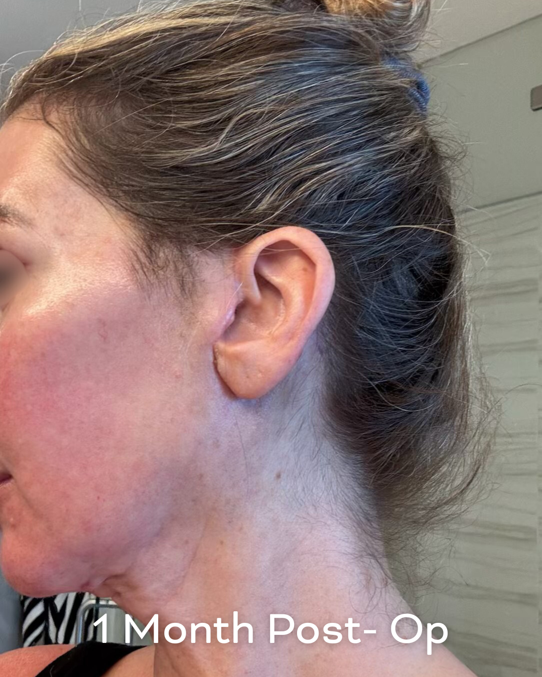 Deep plane lower face and necklift, upper blepharoplasty and Ultrapulse C02 