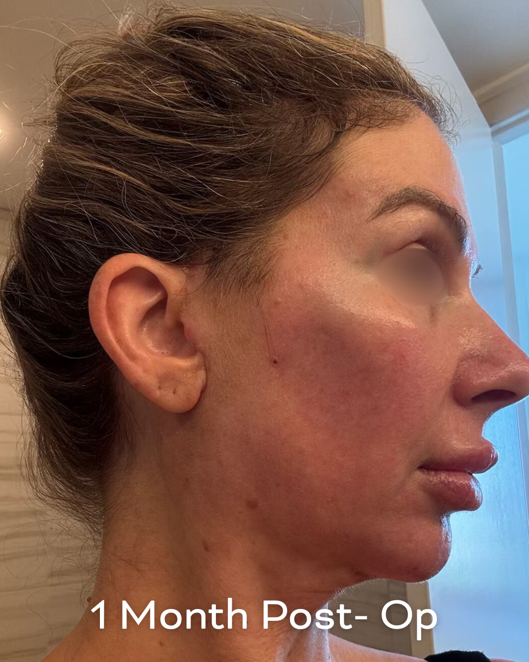 Deep plane lower face and necklift, upper blepharoplasty and Ultrapulse C02 