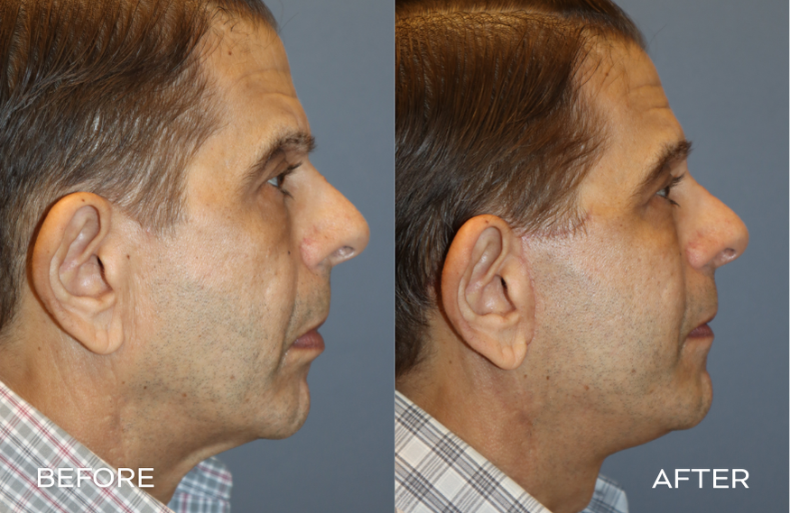 Male Facelift Before and After