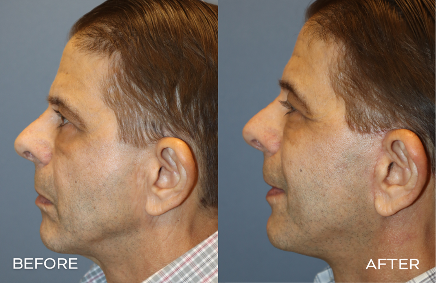 Male Facelift Before and After