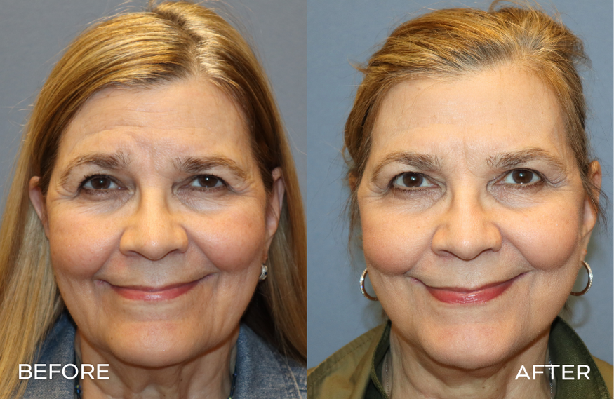 Woman Facelift Before and After