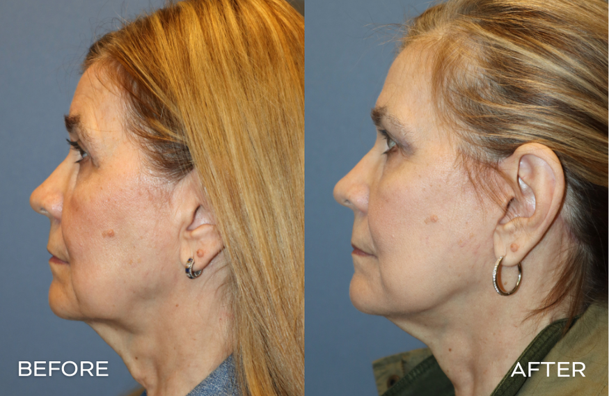 Woman Facelift Before and After