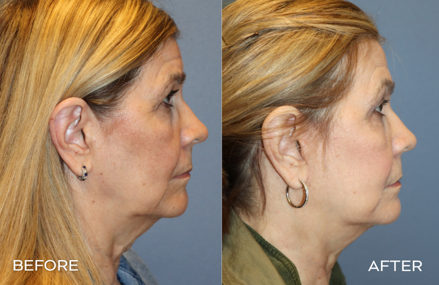 Woman Facelift Before and After