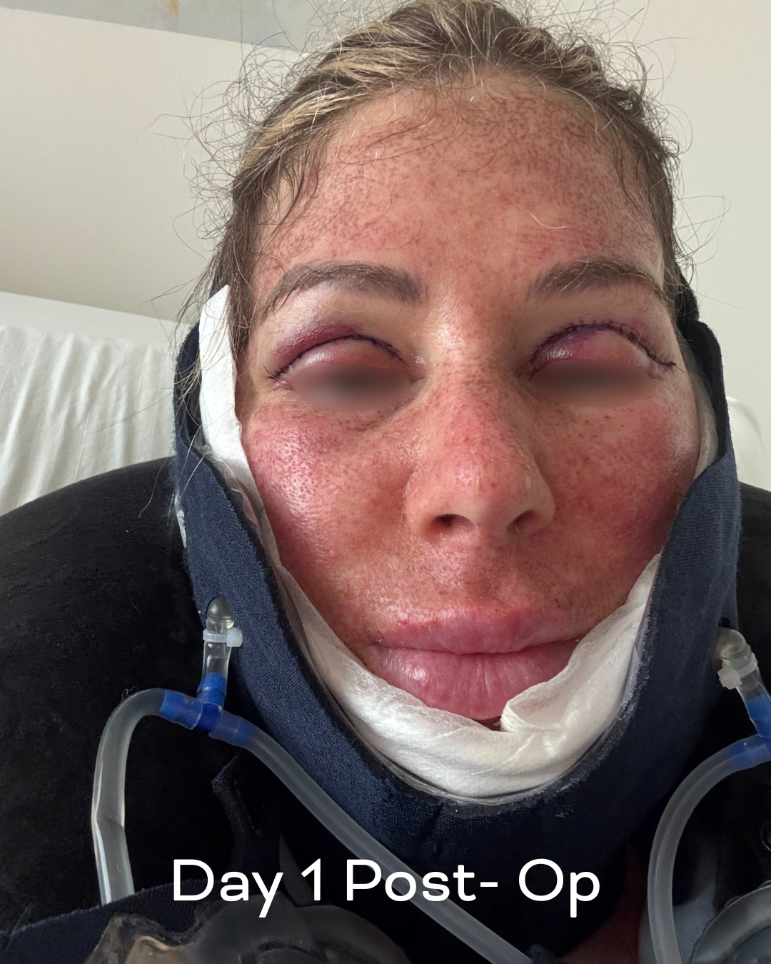 Deep plane lower face and necklift, upper blepharoplasty and Ultrapulse C02 