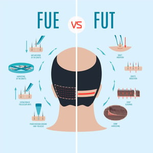 Follicular Unit Extraction in houston