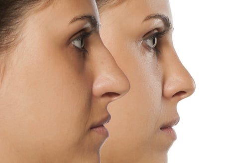 Rinoplastia do nariz em houston texas