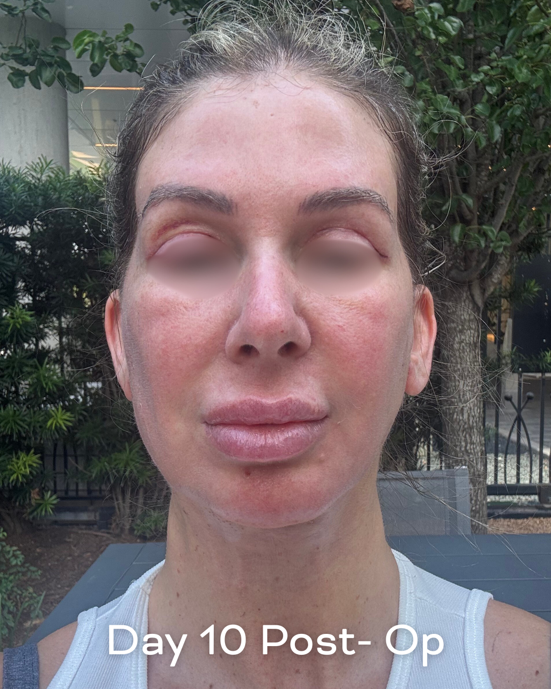 Deep plane lower face and necklift, upper blepharoplasty and Ultrapulse C02 