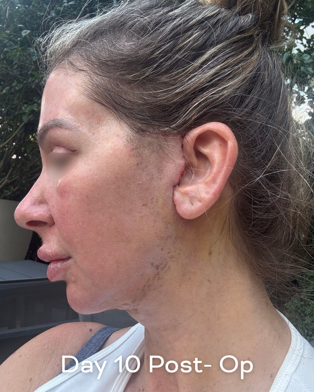 Deep plane lower face and necklift, upper blepharoplasty and Ultrapulse C02 