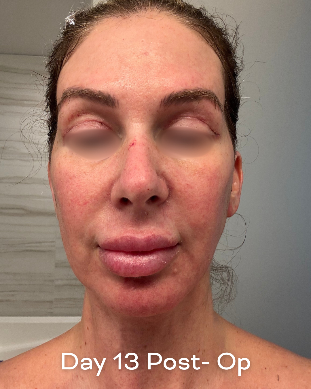 Deep plane lower face and necklift, upper blepharoplasty and Ultrapulse C02 