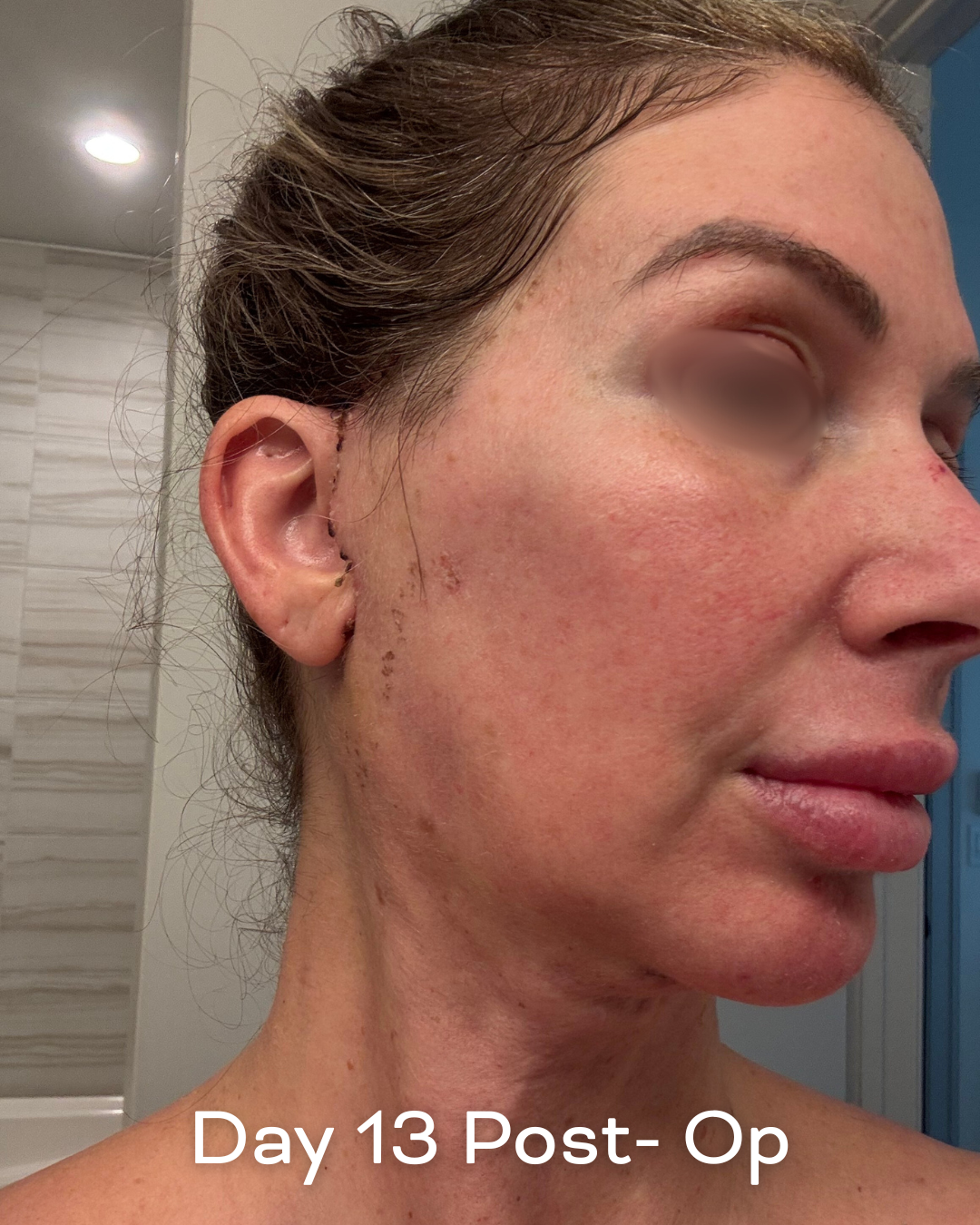 Deep plane lower face and necklift, upper blepharoplasty and Ultrapulse C02 