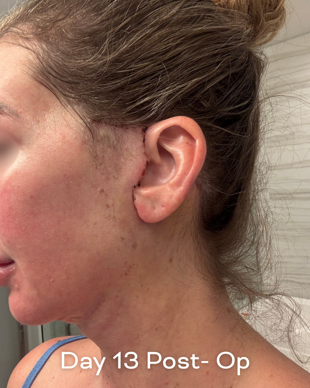Deep plane lower face and necklift, upper blepharoplasty and Ultrapulse C02 