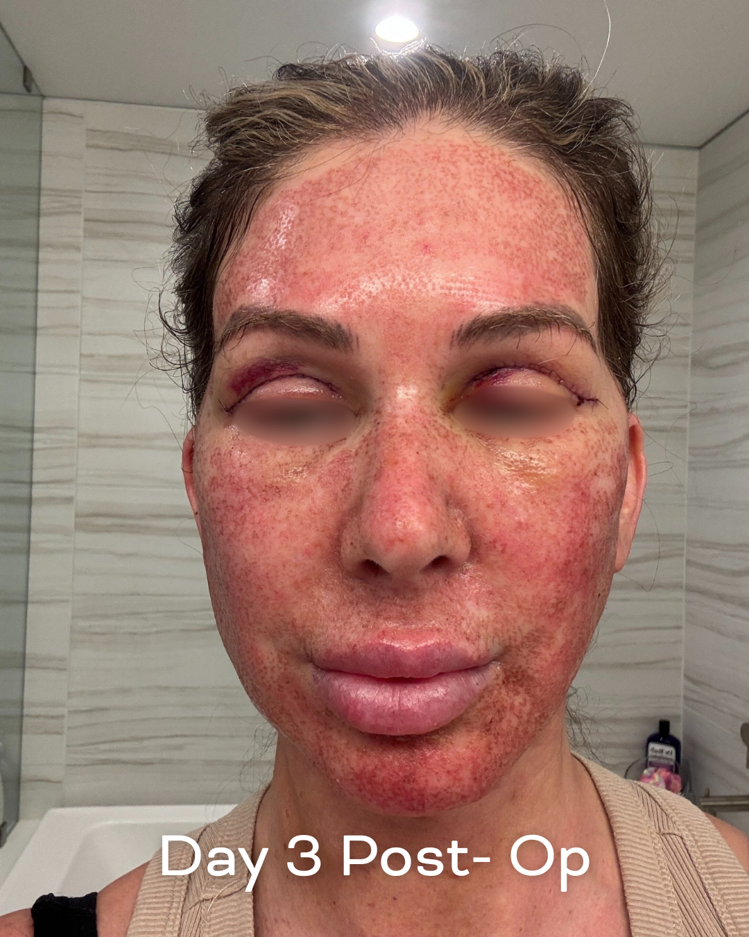 Deep plane lower face and necklift, upper blepharoplasty and Ultrapulse C02 