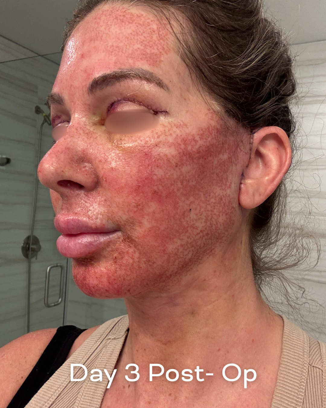 Deep plane lower face and necklift, upper blepharoplasty and Ultrapulse C02 