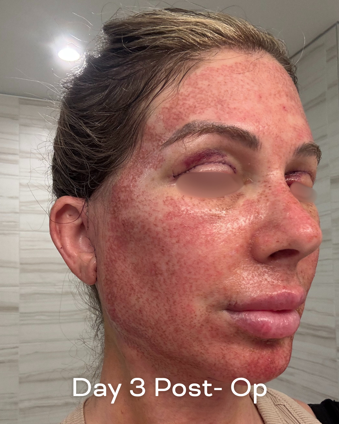 Deep plane lower face and necklift, upper blepharoplasty and Ultrapulse C02 