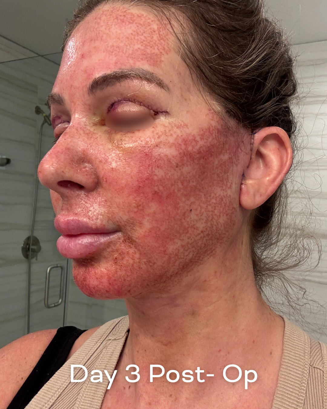 Deep plane lower face and necklift, upper blepharoplasty and Ultrapulse C02 