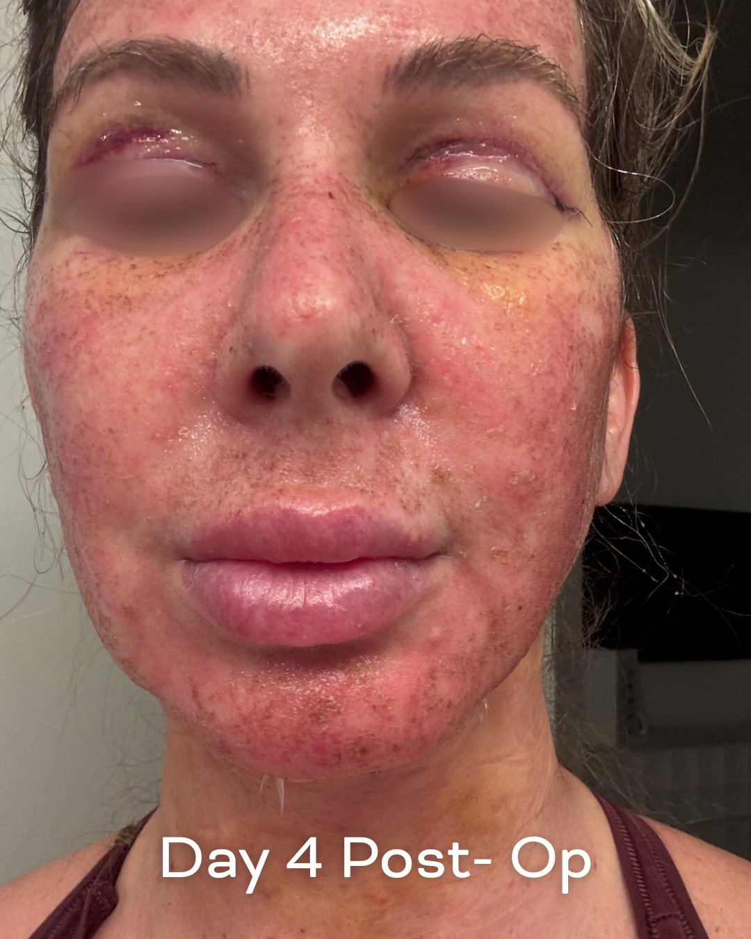 Deep plane lower face and necklift, upper blepharoplasty and Ultrapulse C02 