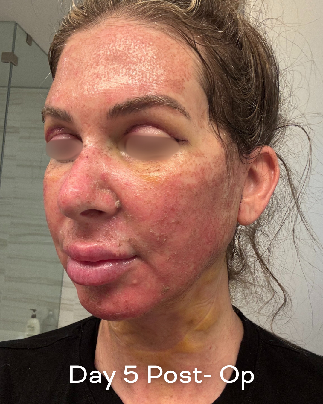 Day Deep plane lower face and necklift, upper blepharoplasty and Ultrapulse C02 