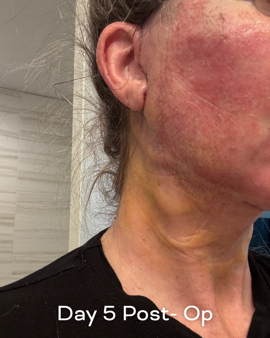 Deep plane lower face and necklift, upper blepharoplasty and Ultrapulse C02 