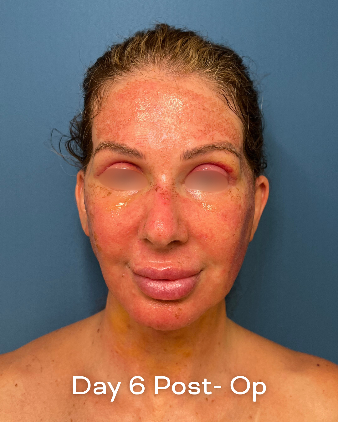 Deep plane lower face and necklift, upper blepharoplasty and Ultrapulse C02 