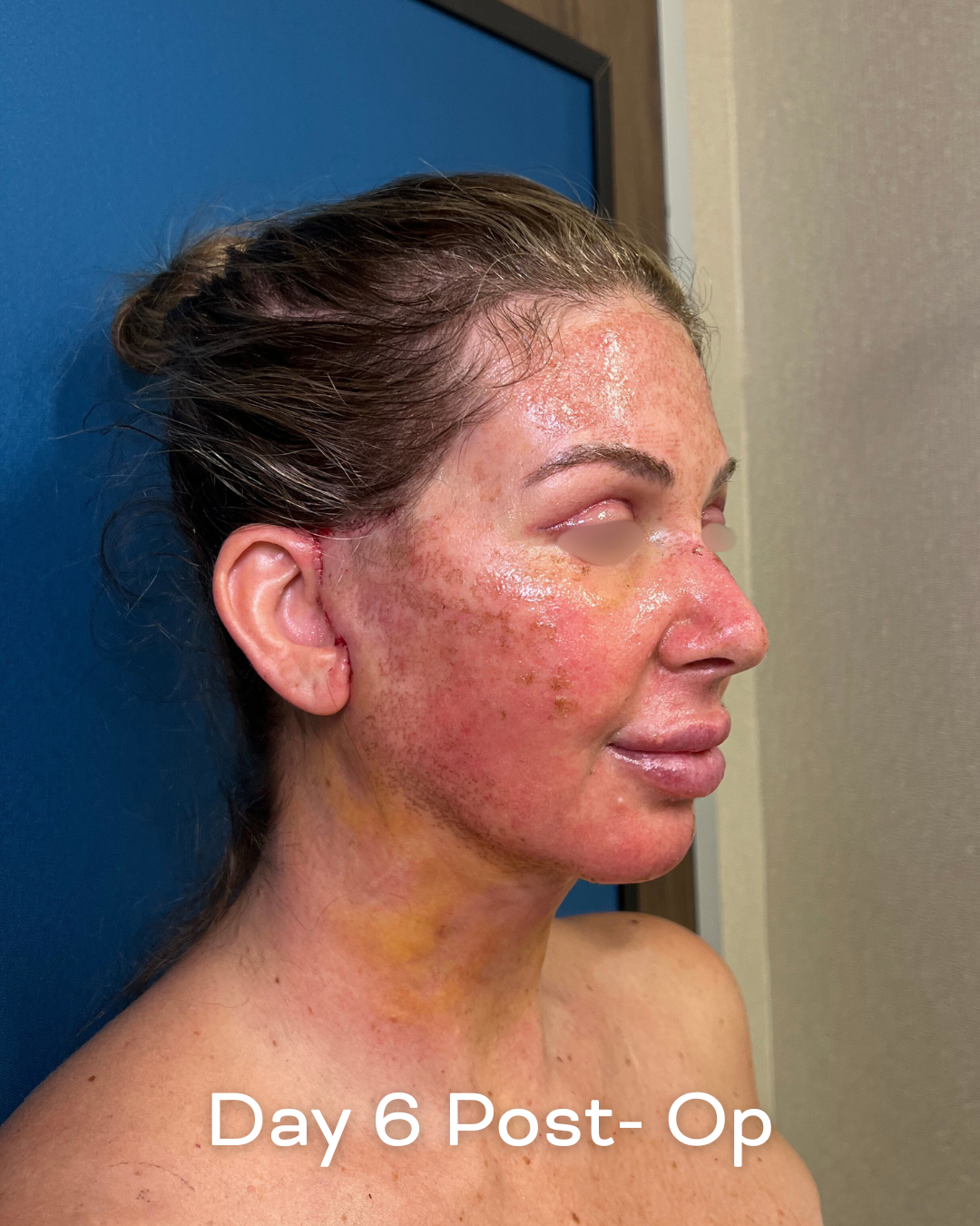 Deep plane lower face and necklift, upper blepharoplasty and Ultrapulse C02 