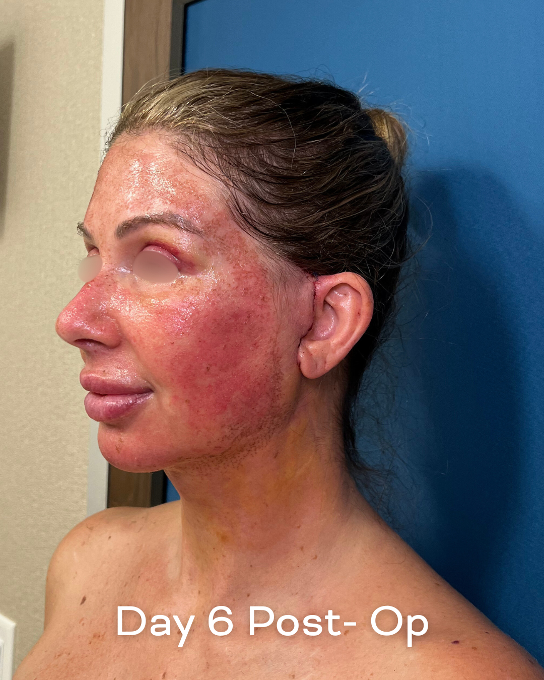 Deep plane lower face and necklift, upper blepharoplasty and Ultrapulse C02 