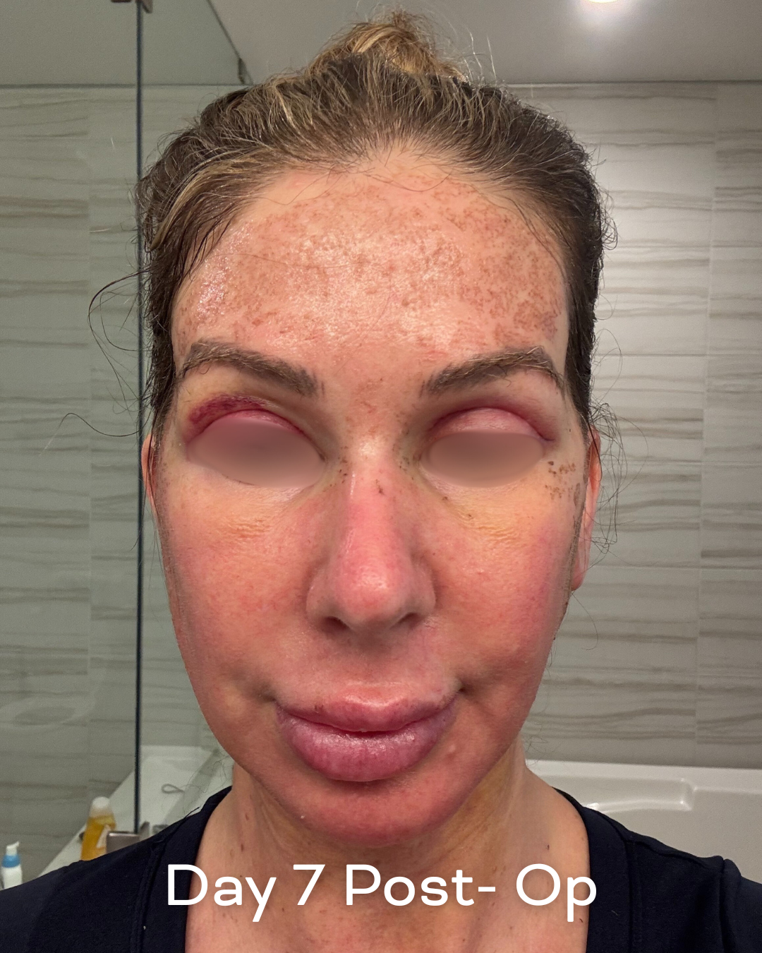 Deep plane lower face and necklift, upper blepharoplasty and Ultrapulse C02 