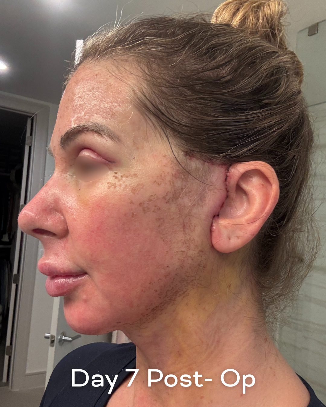 Deep plane lower face and necklift, upper blepharoplasty and Ultrapulse C02 