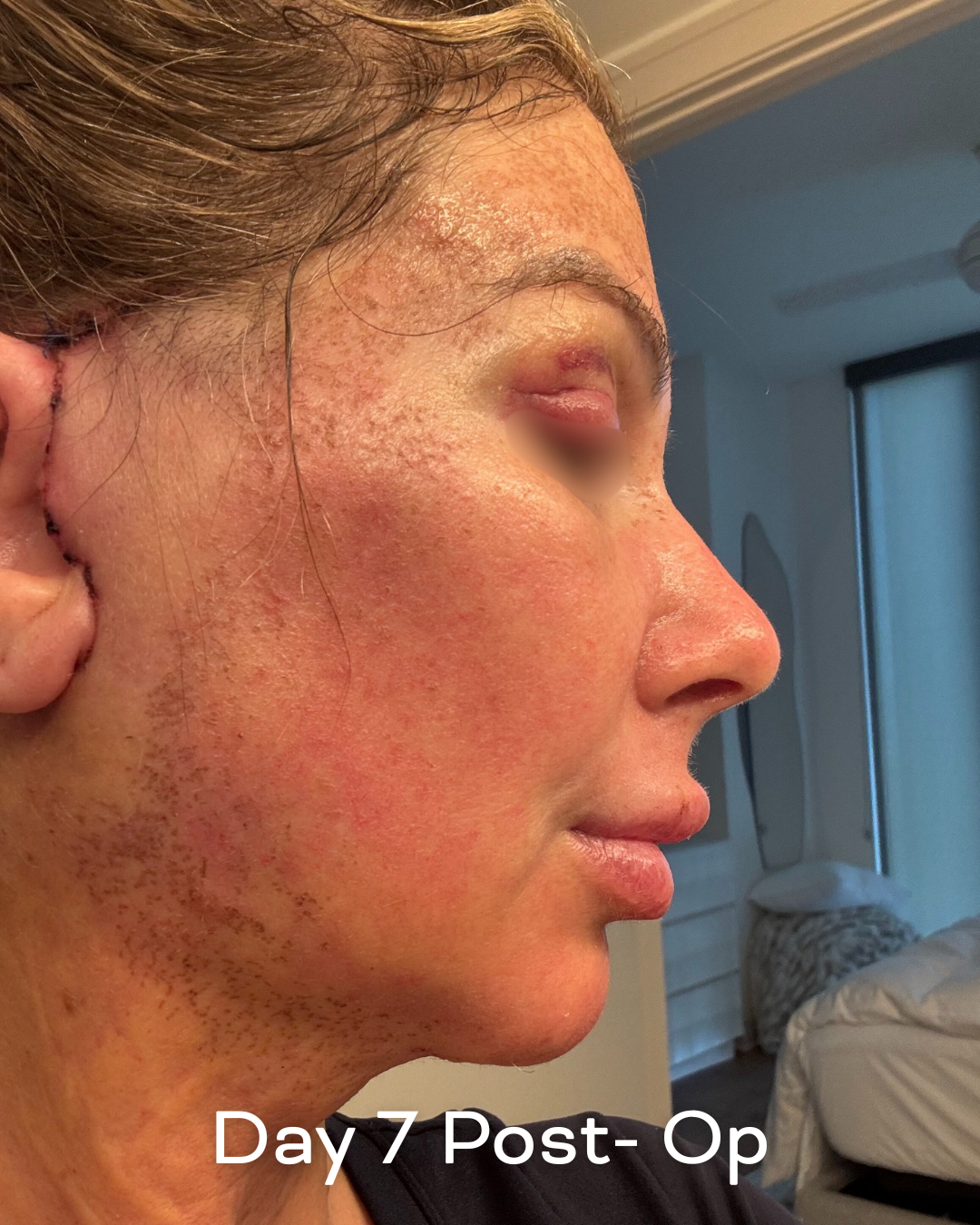 Deep plane lower face and necklift, upper blepharoplasty and Ultrapulse C02 