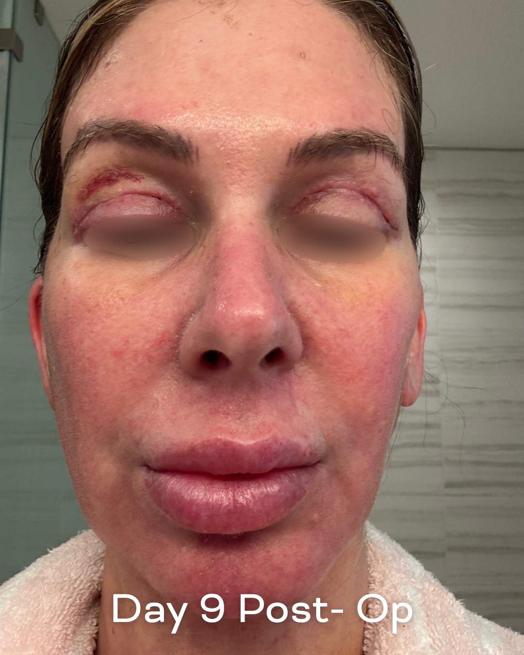 Deep plane lower face and necklift, upper blepharoplasty and Ultrapulse C02 