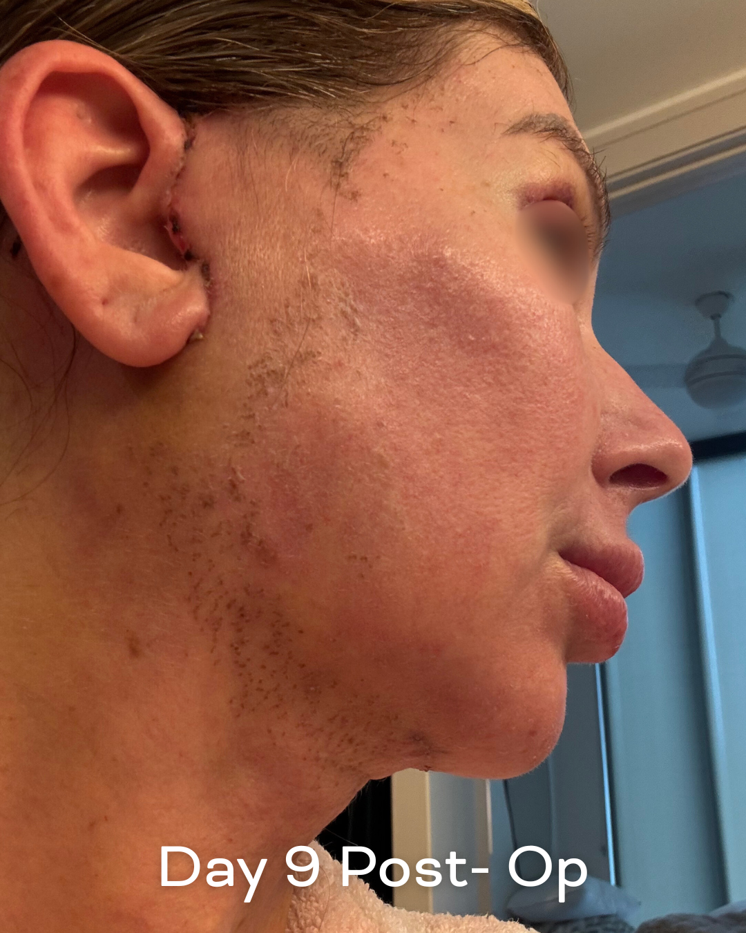 Deep plane lower face and necklift, upper blepharoplasty and Ultrapulse C02 