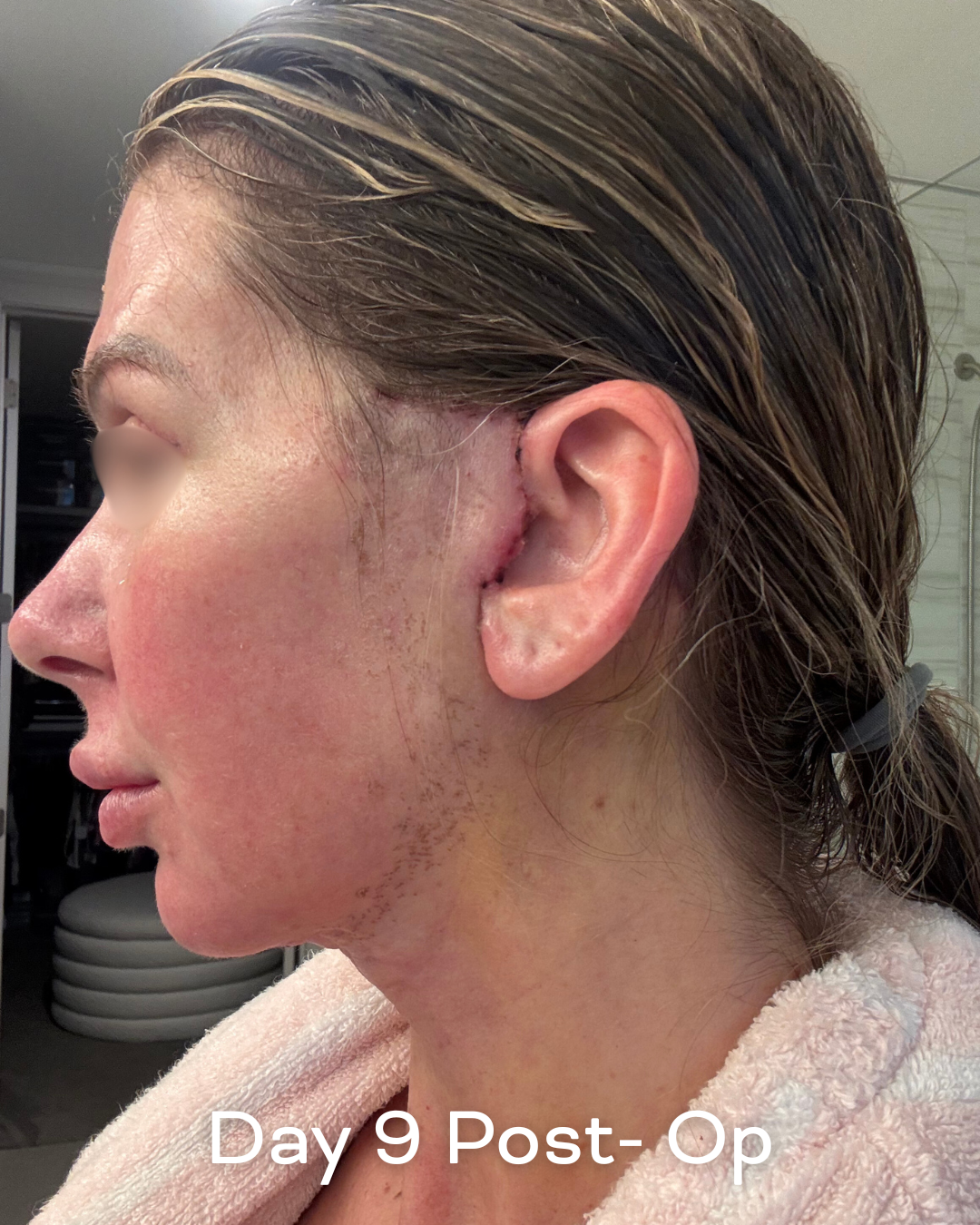 Deep plane lower face and necklift, upper blepharoplasty and Ultrapulse C02 