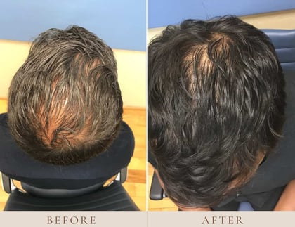 Before and After Hair Restoraation NeoGraft 2