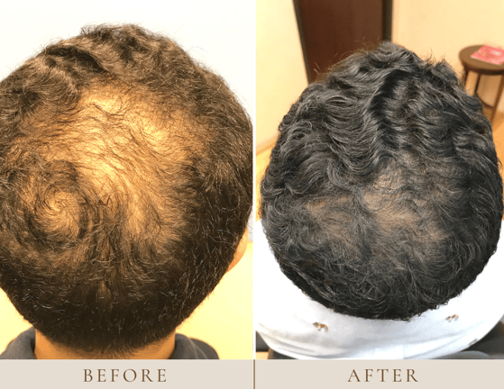How Much Does Hair Transplant (Restoration) Cost in Houston, Texas? Updated  2022