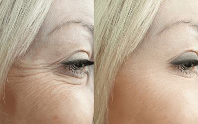 before & after results for botox around eyes crows feet