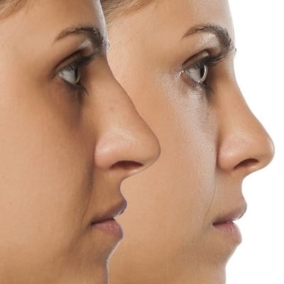 cosmetic nose job in houston texas Cropped (1)
