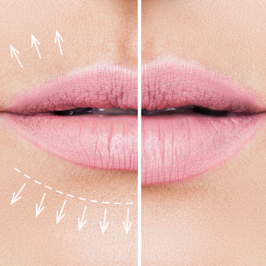 Houston lip filler before and after - lip filler benefits