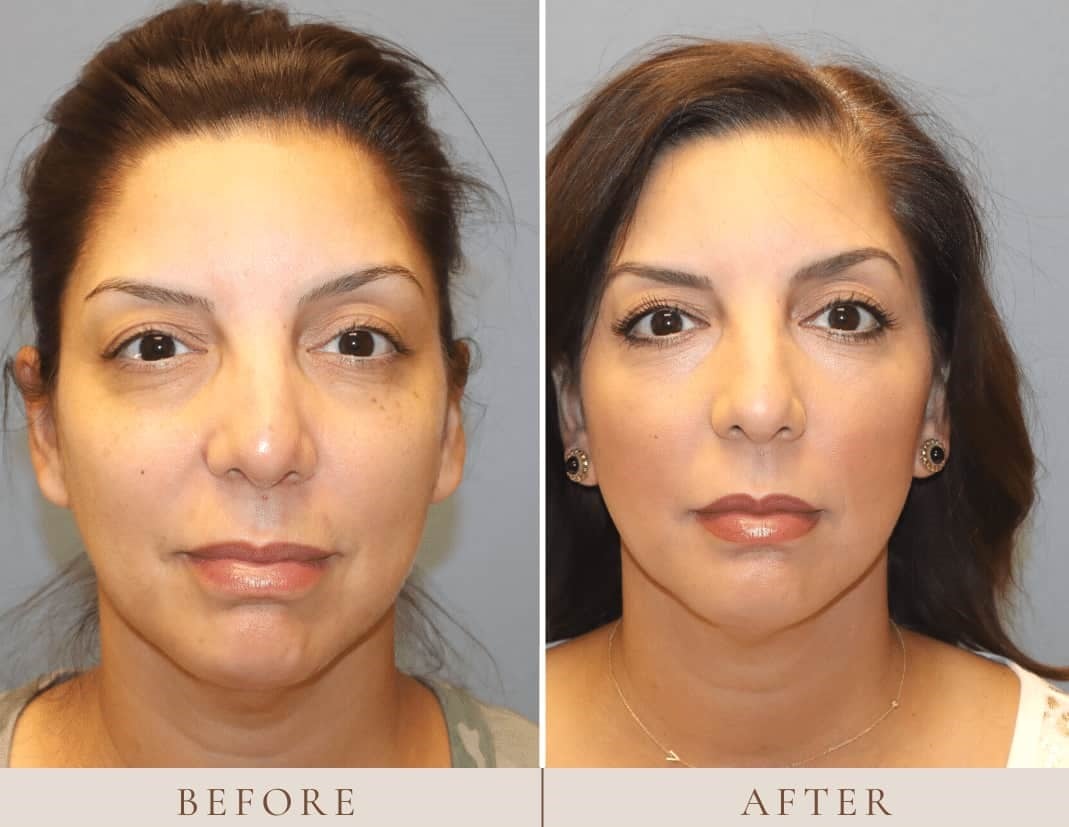 Mini Facelift Procedure in Houston: Benefits, Cost, and Recovery
